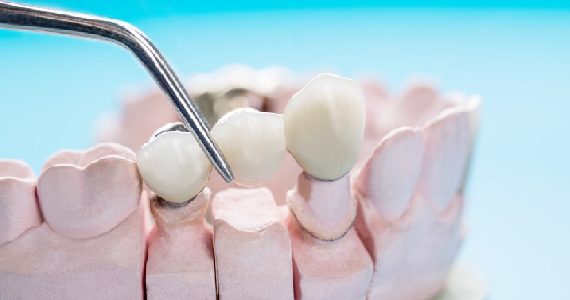 cosmetic dental clinic bangalore 